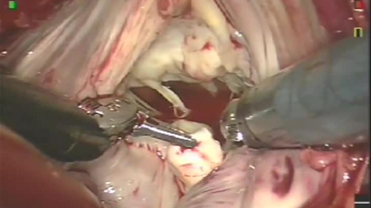 Mitral Valve Repair (MVR) - Leaflet Resection