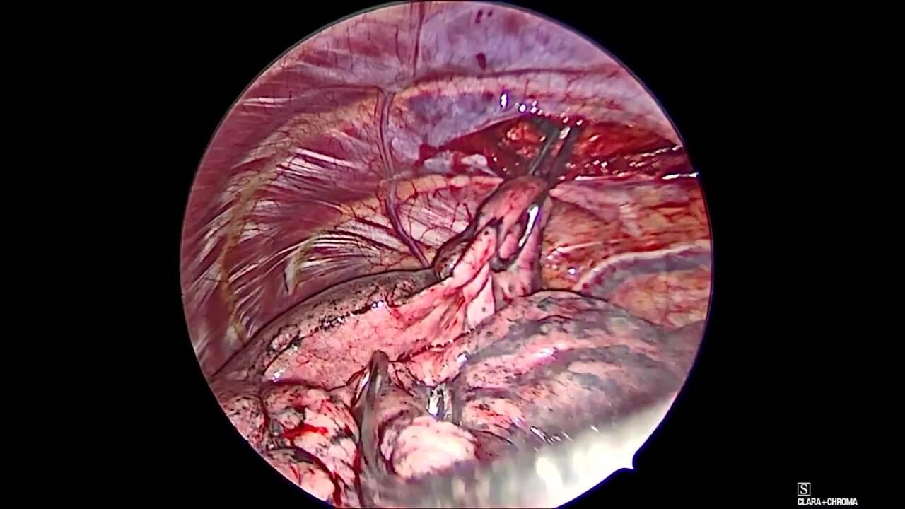 Thorascopic Lobectomy - Manual palpation 