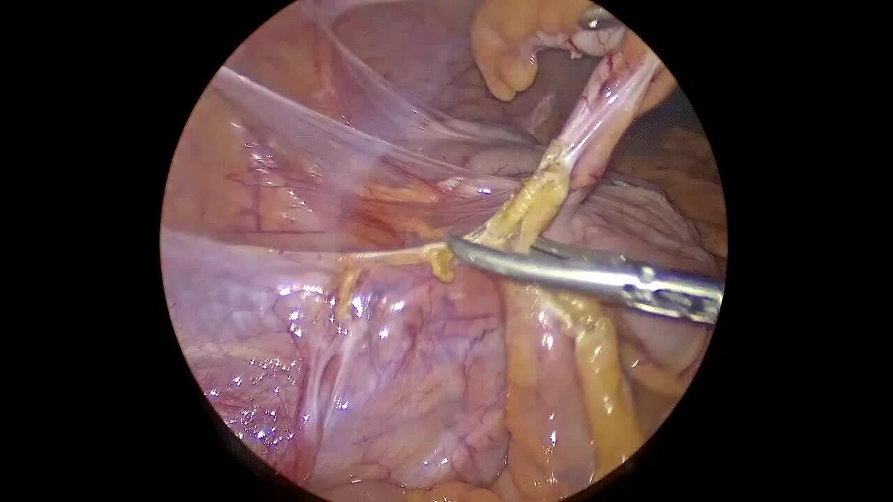 Laparoscopic Appendectomy - Mobilize Appendix