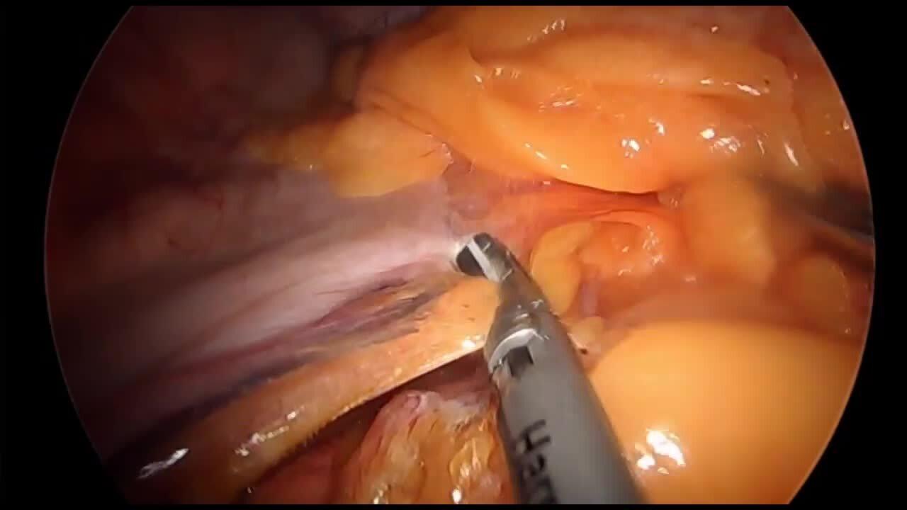 Laparoscopic Sleeve Gastrectomy - Mobilize Greater Curvature