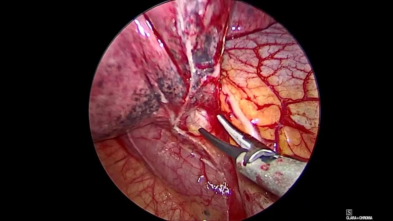 Thorascopic Lobectomy - Mobilize the Inferior Pulmonary Ligament