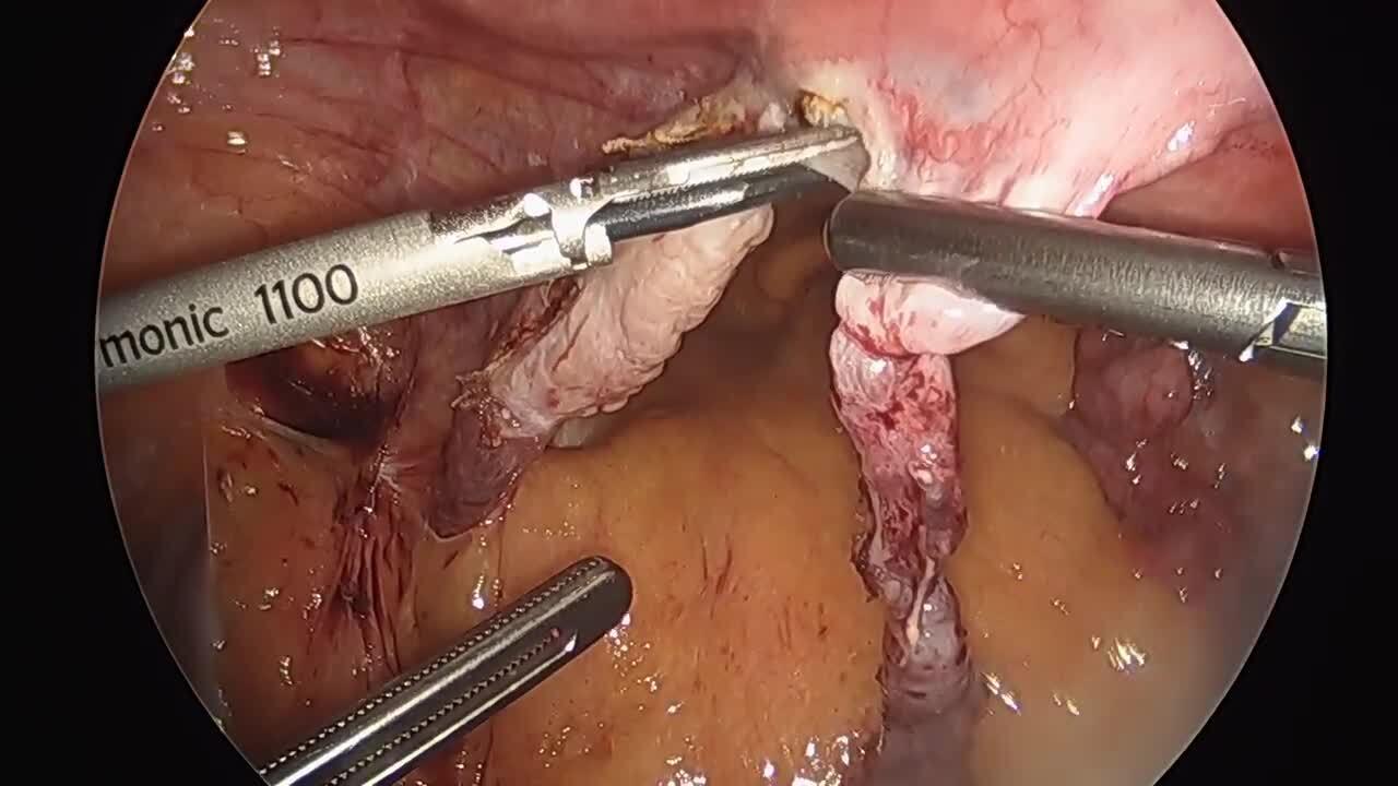 Total Laparoscopic Hysterectomy - Transect Utero-Ovarian Ligaments