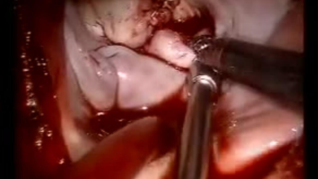 Mitral Valve Repair (MVR) - Pericardial Patch Final