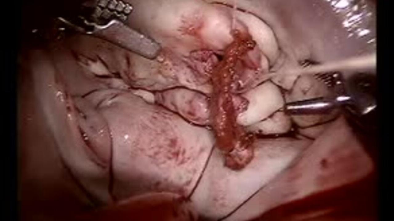 Mitral Valve Repair (MVR) - Pericardial Patch Repair