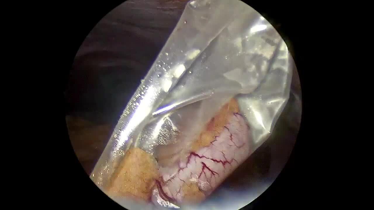 Laparoscopic Appendectomy - Specimen Removal