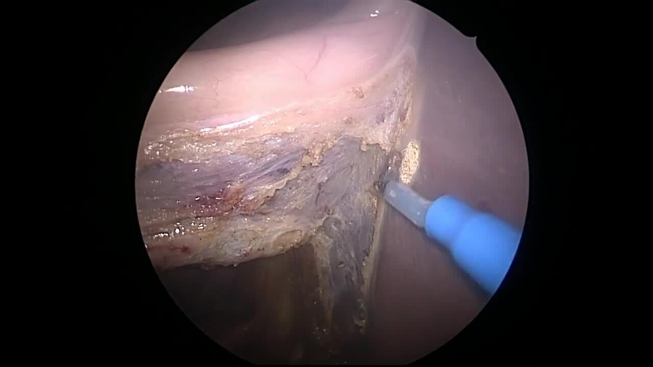 Laparoscopic Cholecystectomy - Mobilize Gallbladder