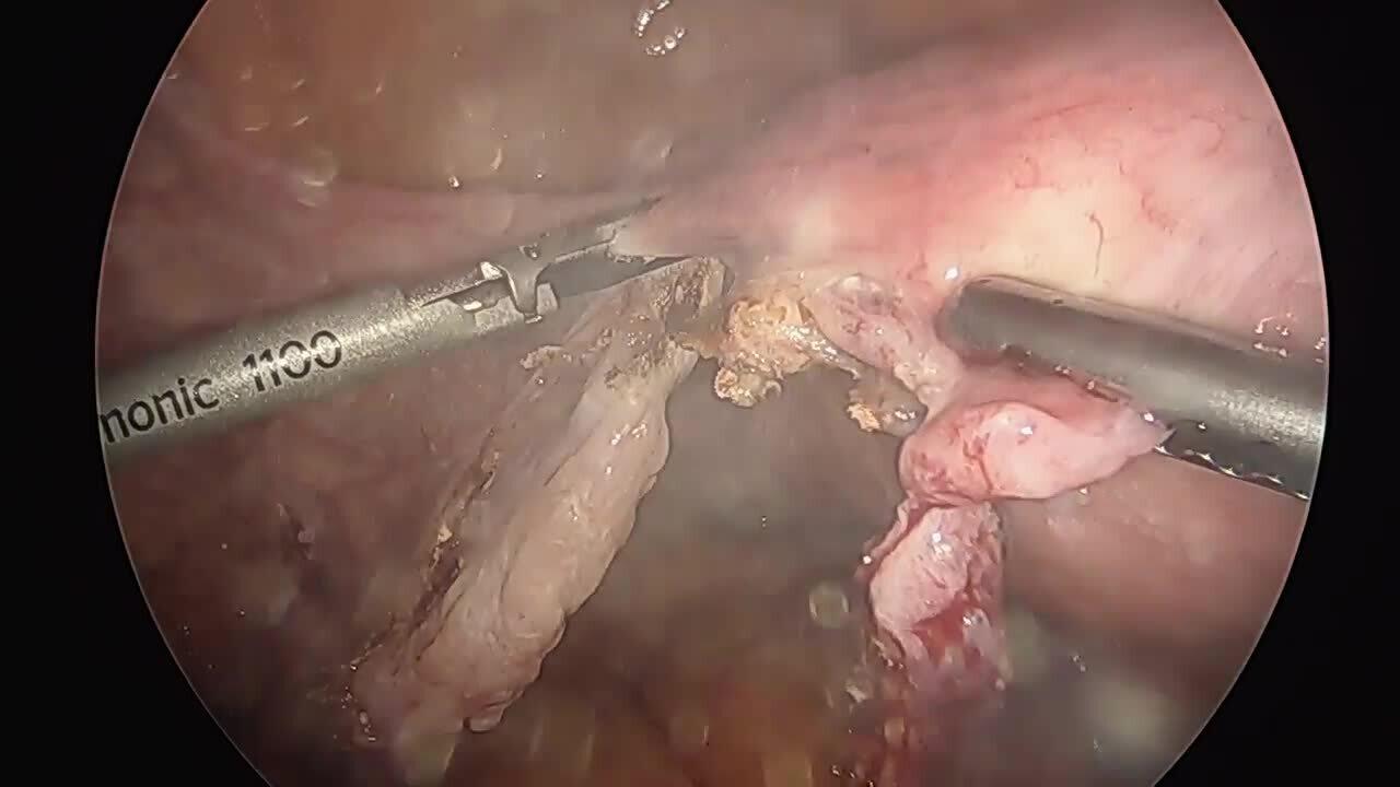 Total Laparoscopic Hysterectomy - Ligate & Divide Round Ligaments