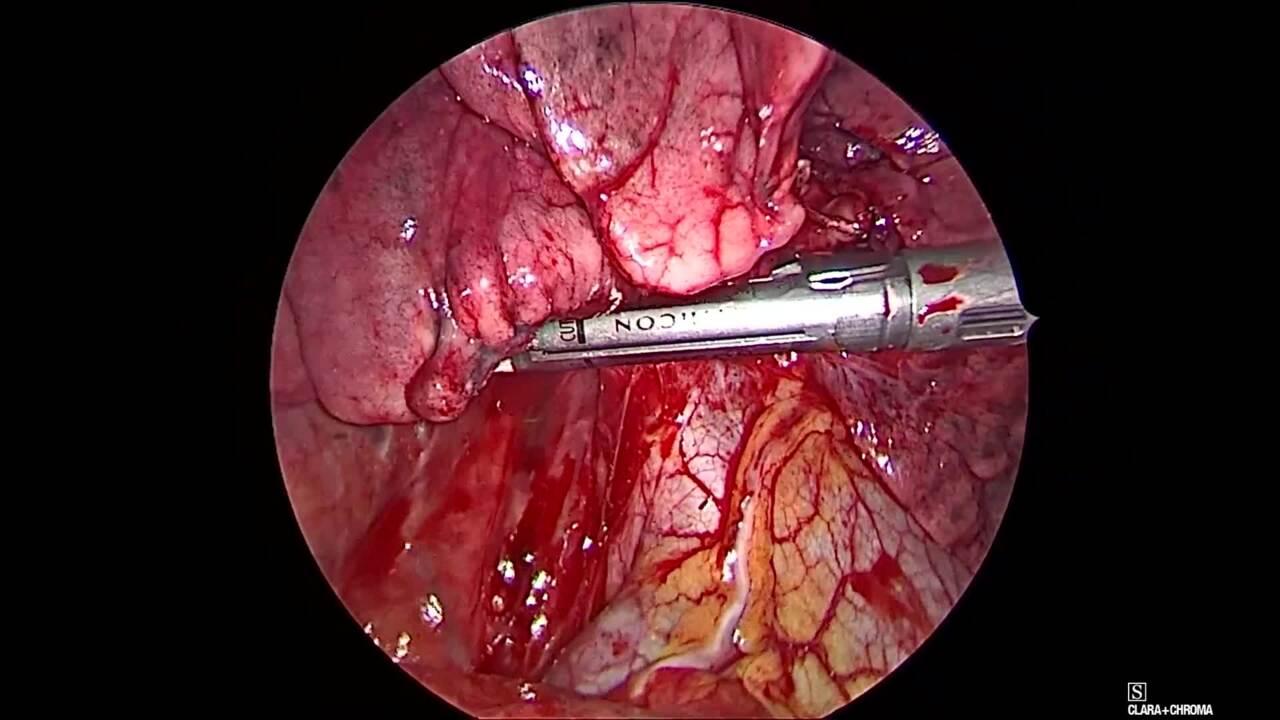 Thorascopic Lobectomy - Staple and Divide the Pulmonary Vein