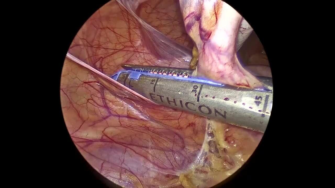 Laparoscopic Appendectomy - Transect the Appendix