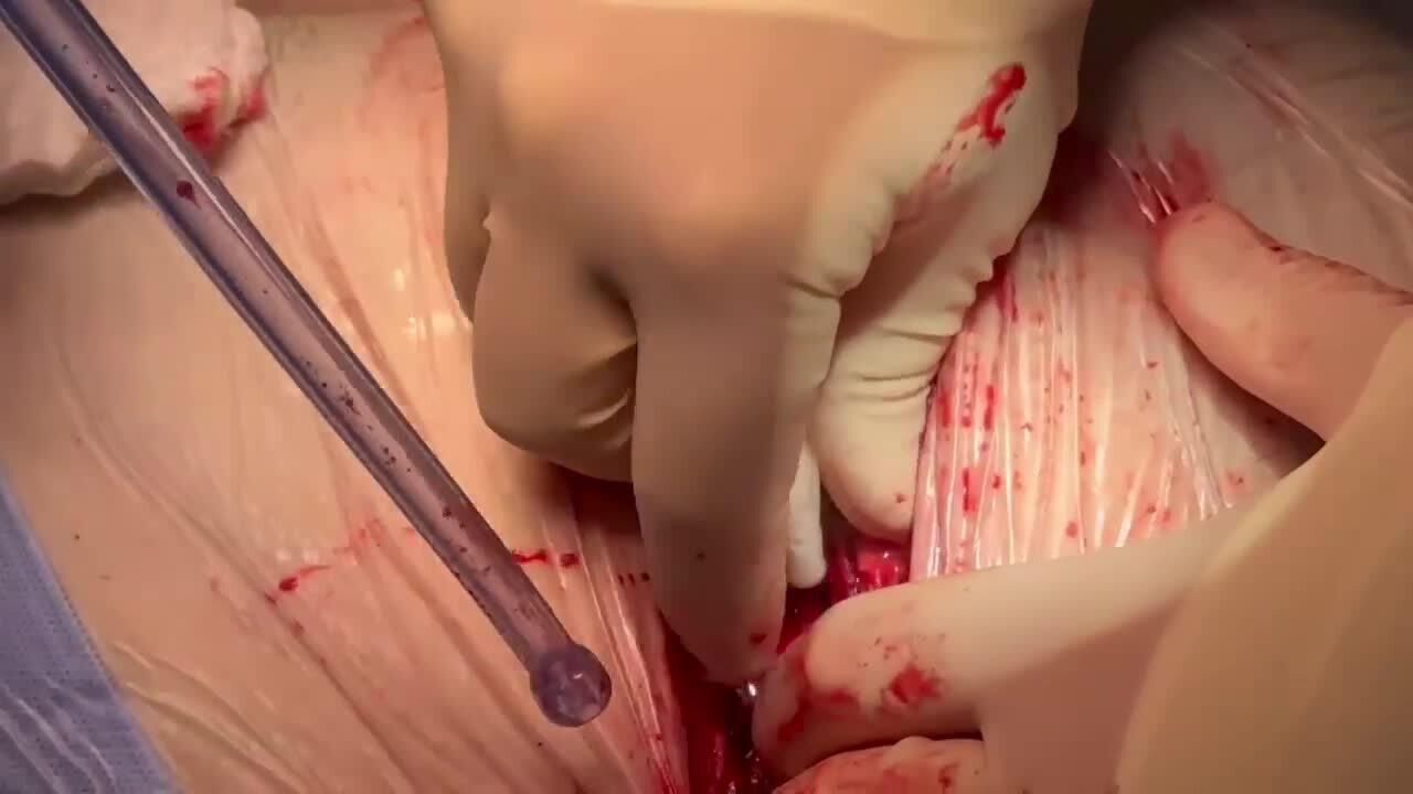 Coronary Artery Bypass Grafting (CABG) - Sternotomy Hemostasis