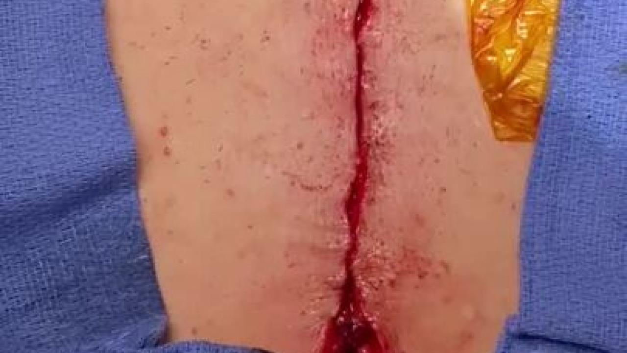 Mitral Valve Repair (MVR) - Closure STRATAFIX 1/3