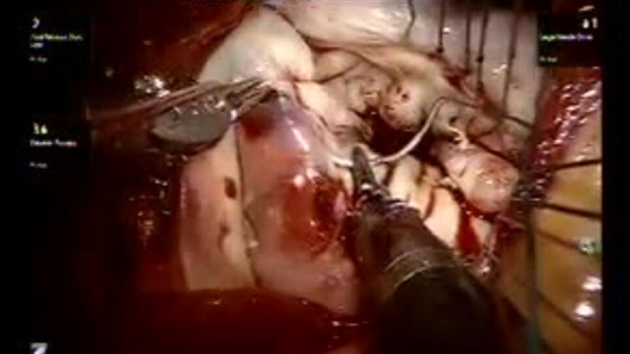 Mitral Valve Repair (MVR) - Annuloplasty 2/3