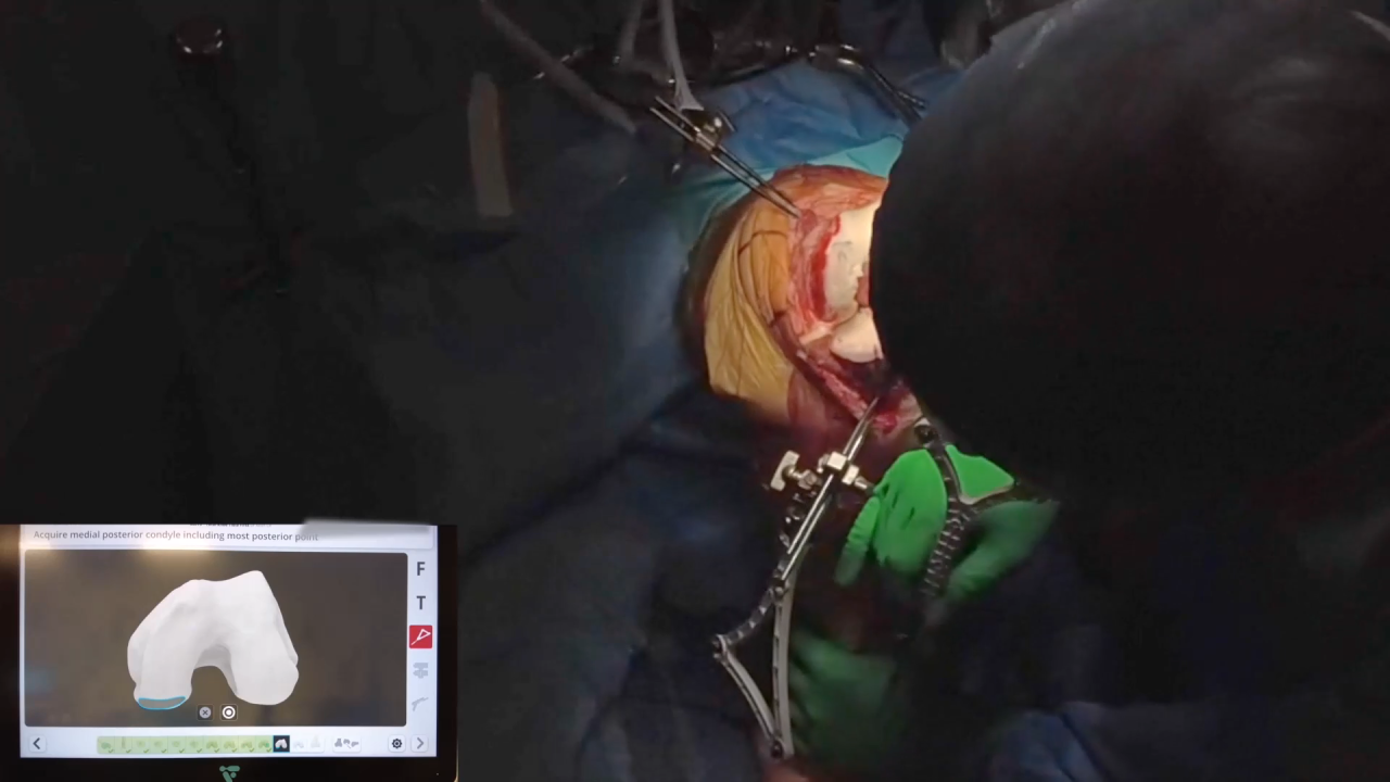 VELYS™ Robotic-Assisted Solution: Tibia First PSA with Dr. Timothy Alton thumbnail image