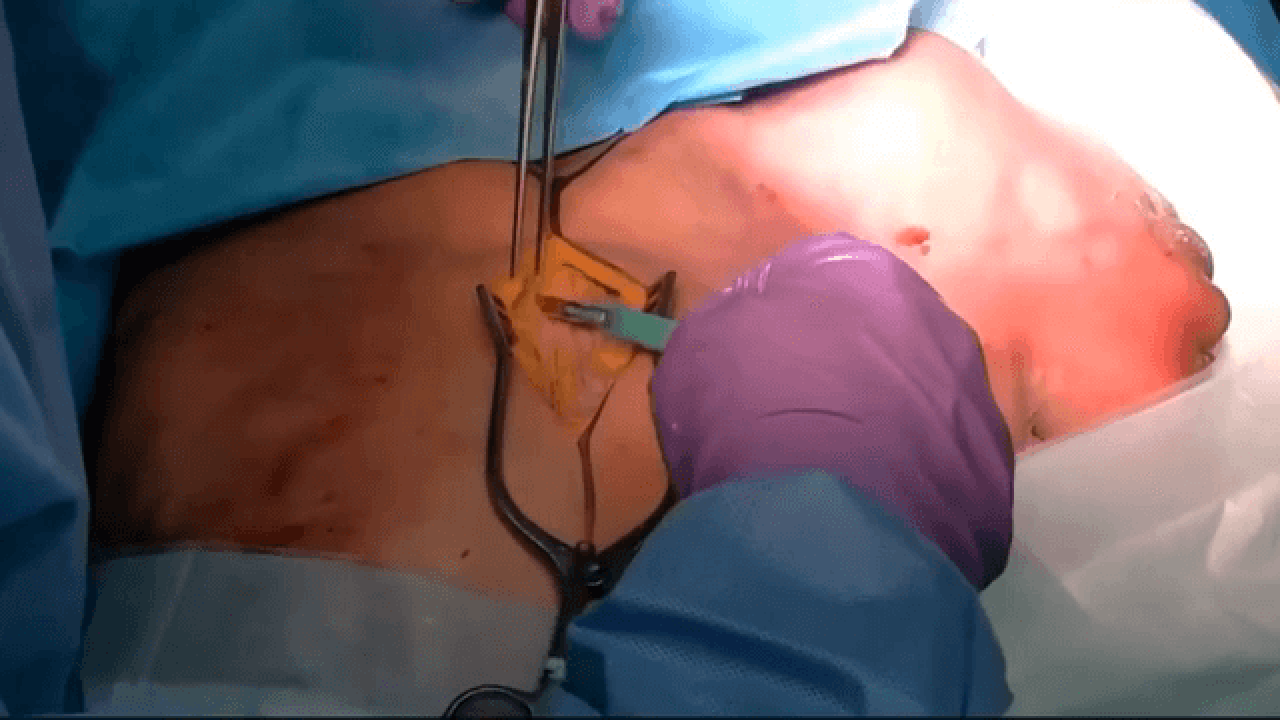MatrixRIB™ System for Rib Fracture Fixation: Posterior Approach Presented by Nir Hus, MD thumbnail
