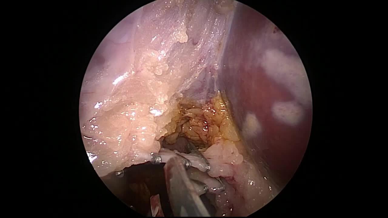 Laparoscopic Cholecystectomy - Transect Cystic Duct & Artery