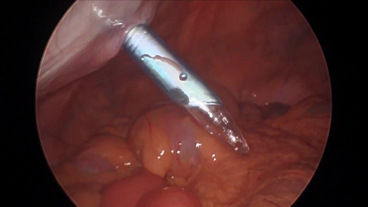 Laparoscopic Right Hemicolectomy - Insert Trocars