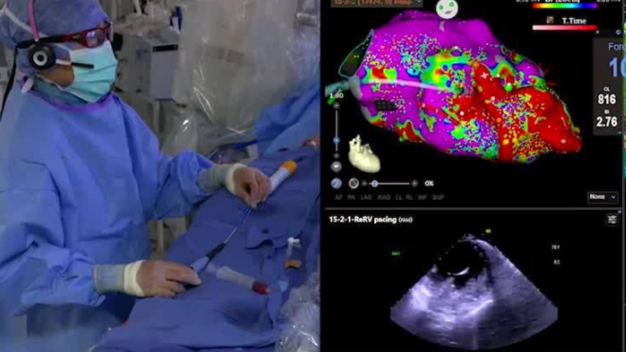 Ischemic VT with Optrell