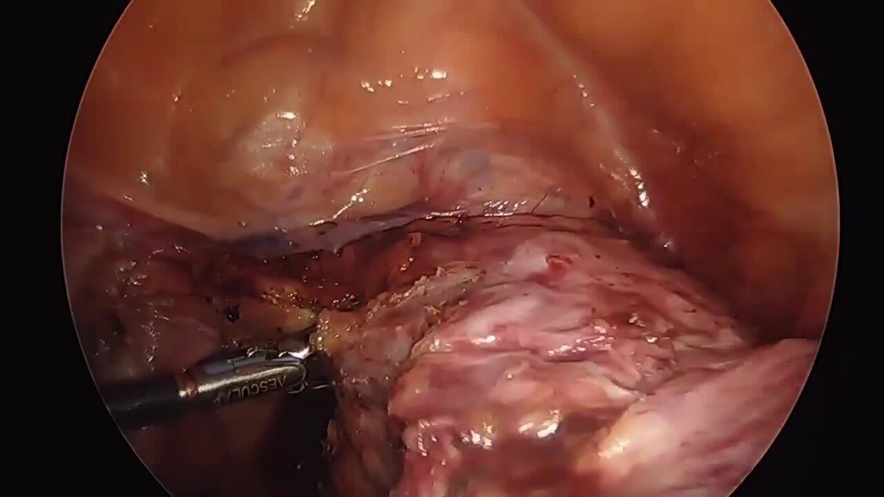 Total Laparoscopic Hysterectomy - Divide & Ligate Uterine Arteries
