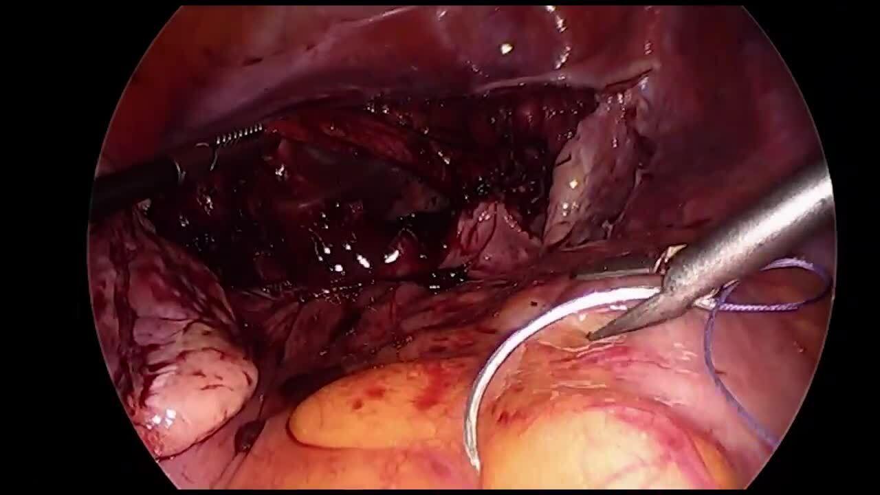 Total Laparoscopic Hysterectomy - Vaginal Cuff Closure