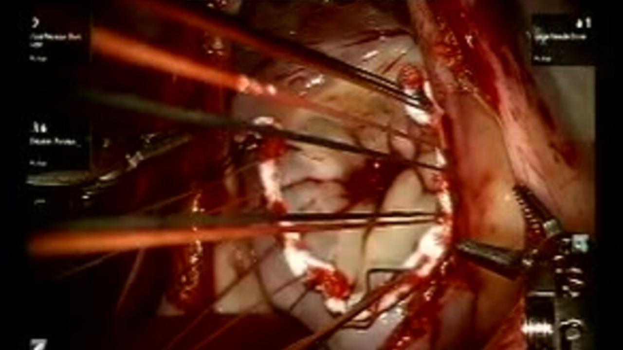 Mitral Valve Repair (MVR) - Annuloplasty 3/3