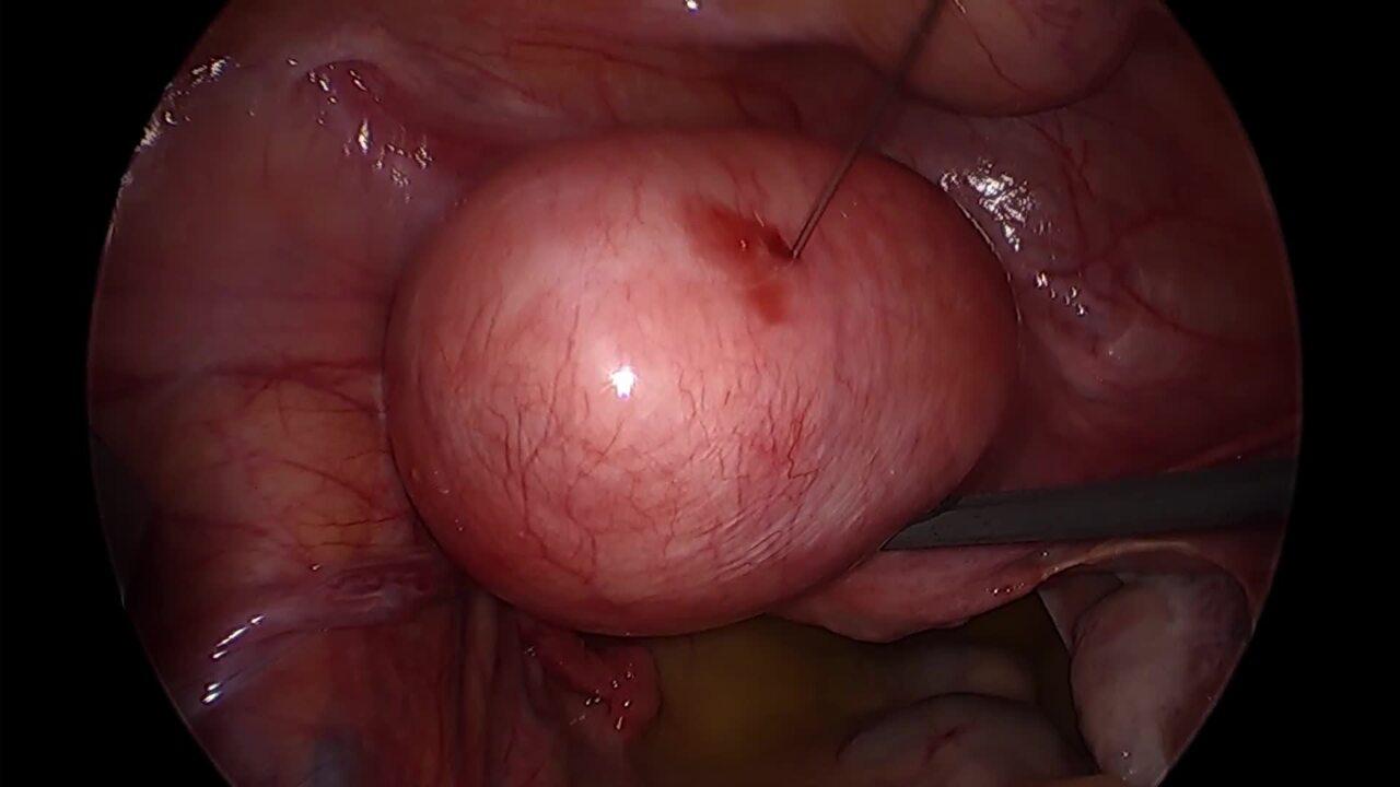 Laparoscopic Myomectomy - Locate Fibroid & Inject Vasopressin