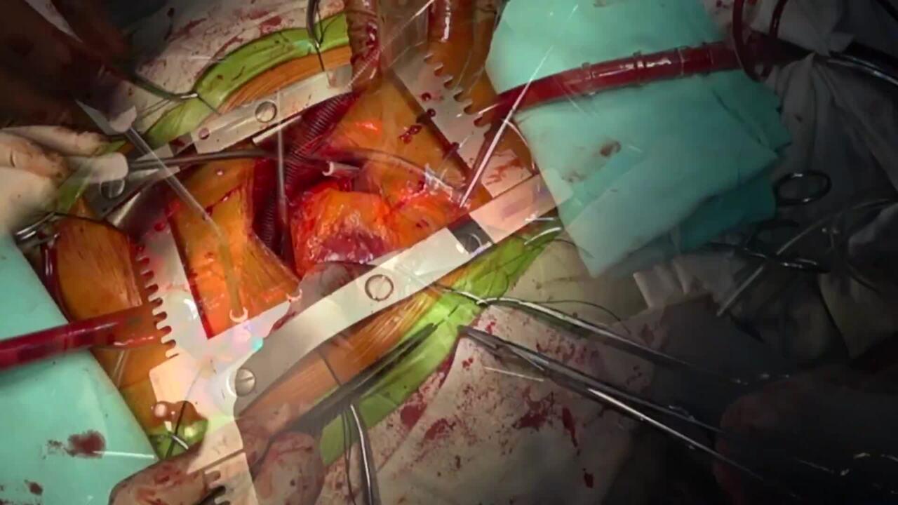 Aortic Valve Replacement (AVR) - Venous Cannula Placement