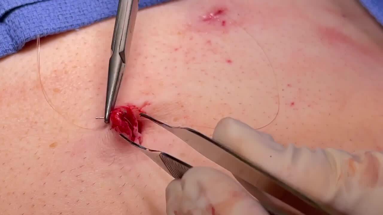 Laparoscopic Cholecystectomy - Remove Trocars & Close