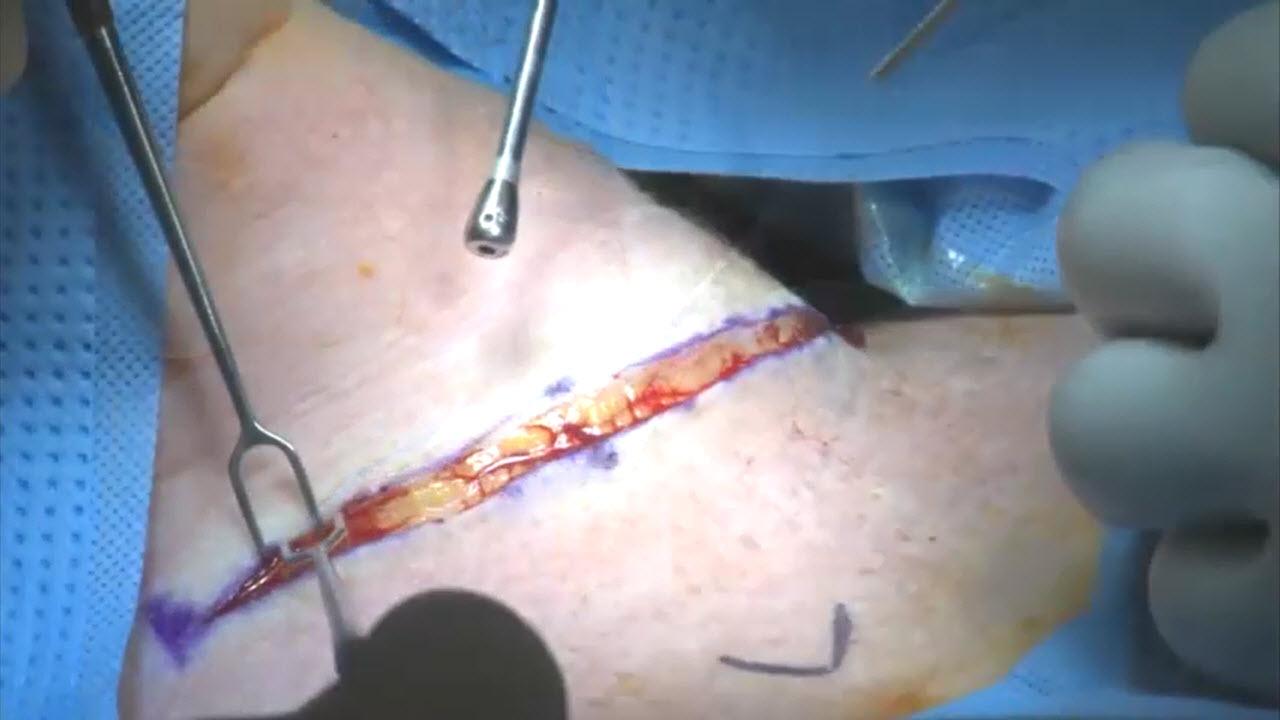 An image of the "Thyroidectomy using HARMONIC FOCUS+ Shears with Phillip Pellitteri, DO, FACS" video.