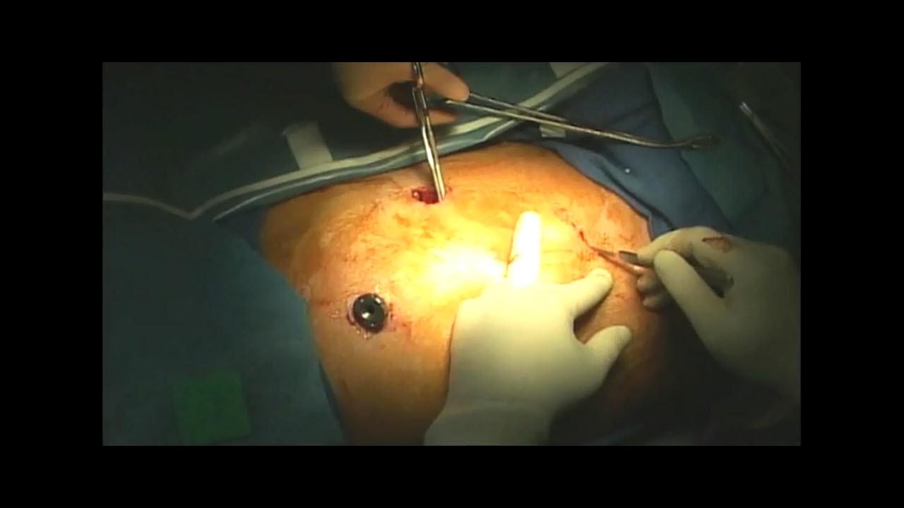An image of the "Left Upper Lobectomy Techniques with Robert McKenna, MD" video.