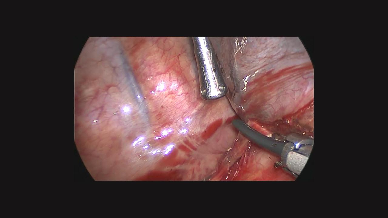 An image of the "Lymph Node Dissection During Right Upper Lobectomy: Zane Hammoud, MD" video.