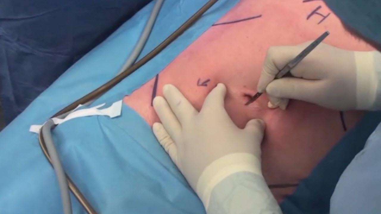An image of the "Laparoscopic Repair of Direct Inguinal Hernia with TEP Approach - Tim Tollens, MD" video.
