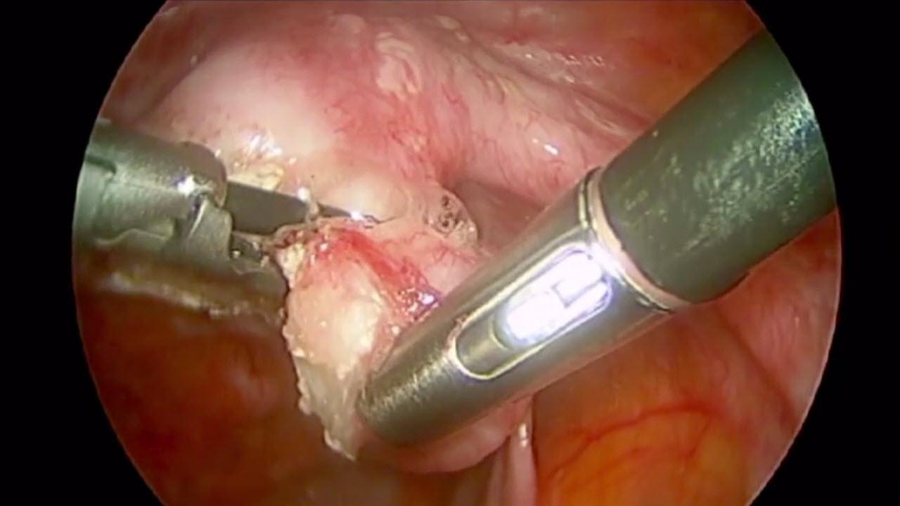 An image from the "Laparoscopic Salpingo-Oophorectomy with HARMONIC ACE+7 Shears with Steven McCarus, MD" video on the JnJInstitute.com website.