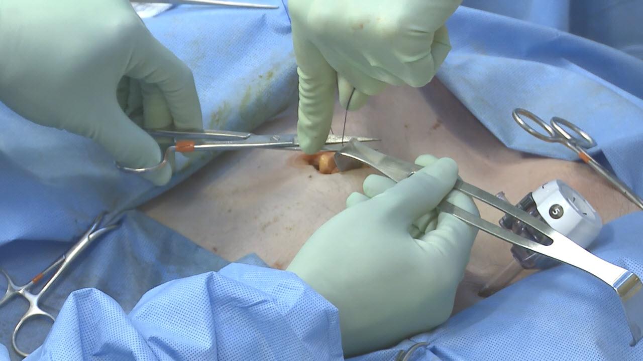 Laparoscopic Right Colectomy: Step 7 Close with David Longcope, MD