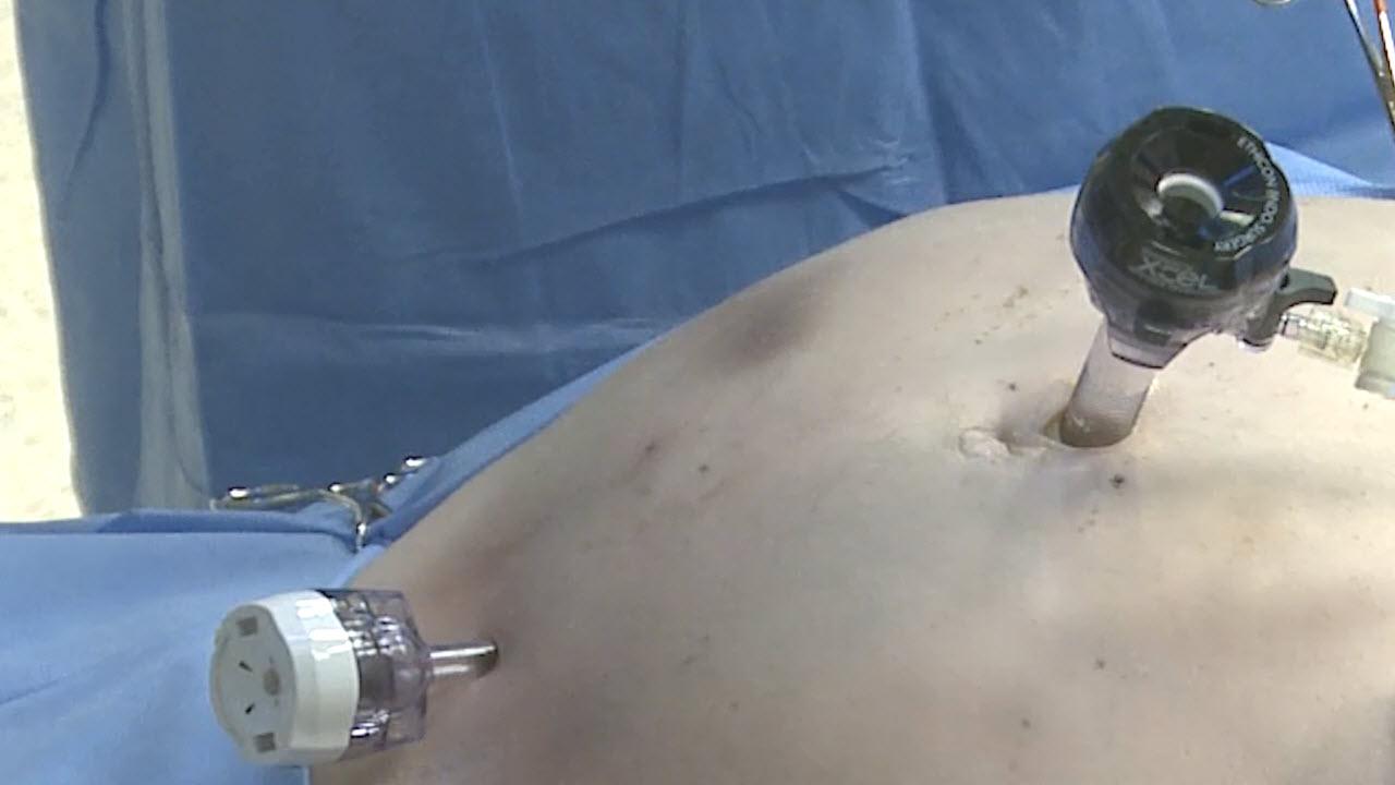 An image of the "Laparoscopic Left Colectomy & LAR: Port Placement with David Longcope, MD" video.
