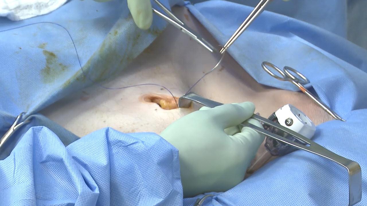 An image of the "Laparoscopic Left Colectomy & LAR - Step 6a: Exteriorize Resect & Place Anvil with David Longcope, MD" video.