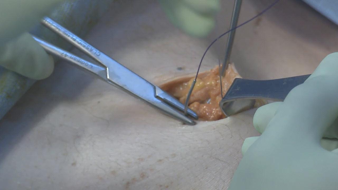 An image of the "Laparoscopic Left Colectomy & LAR - Step 6b: Exteriorize, Resect, Anvil (Purse String) with David Longcope, MD" video.