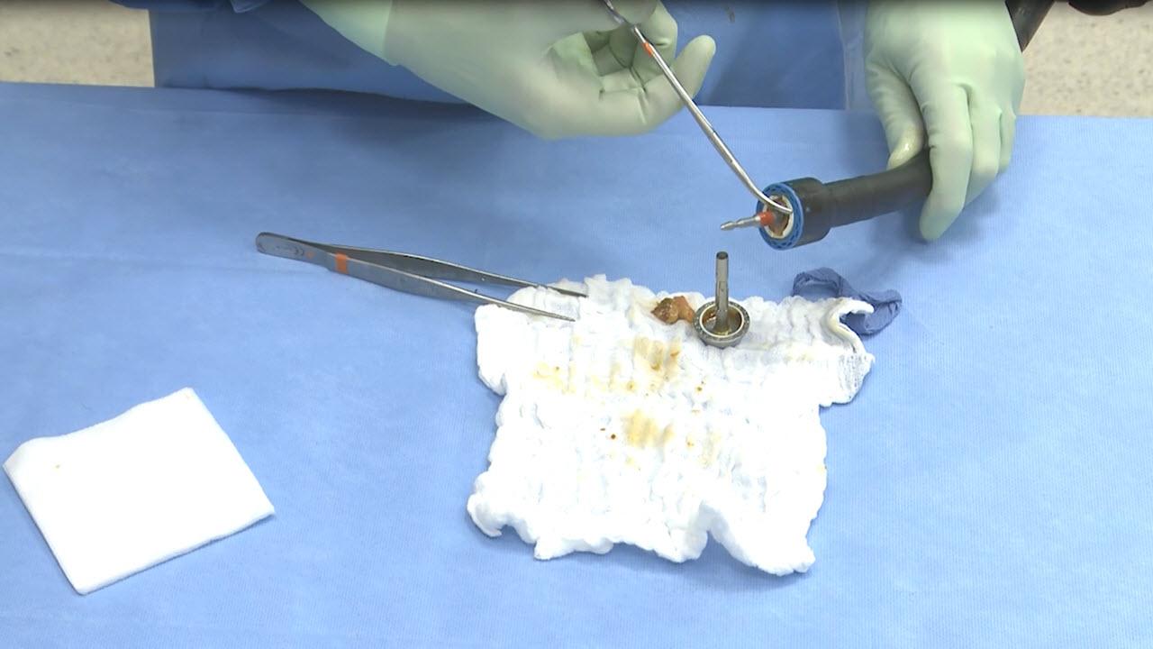 An image of the "Laparoscopic Left Colectomy & LAR - Step 7: Create Anastomosis with David Longcope, MD" video.