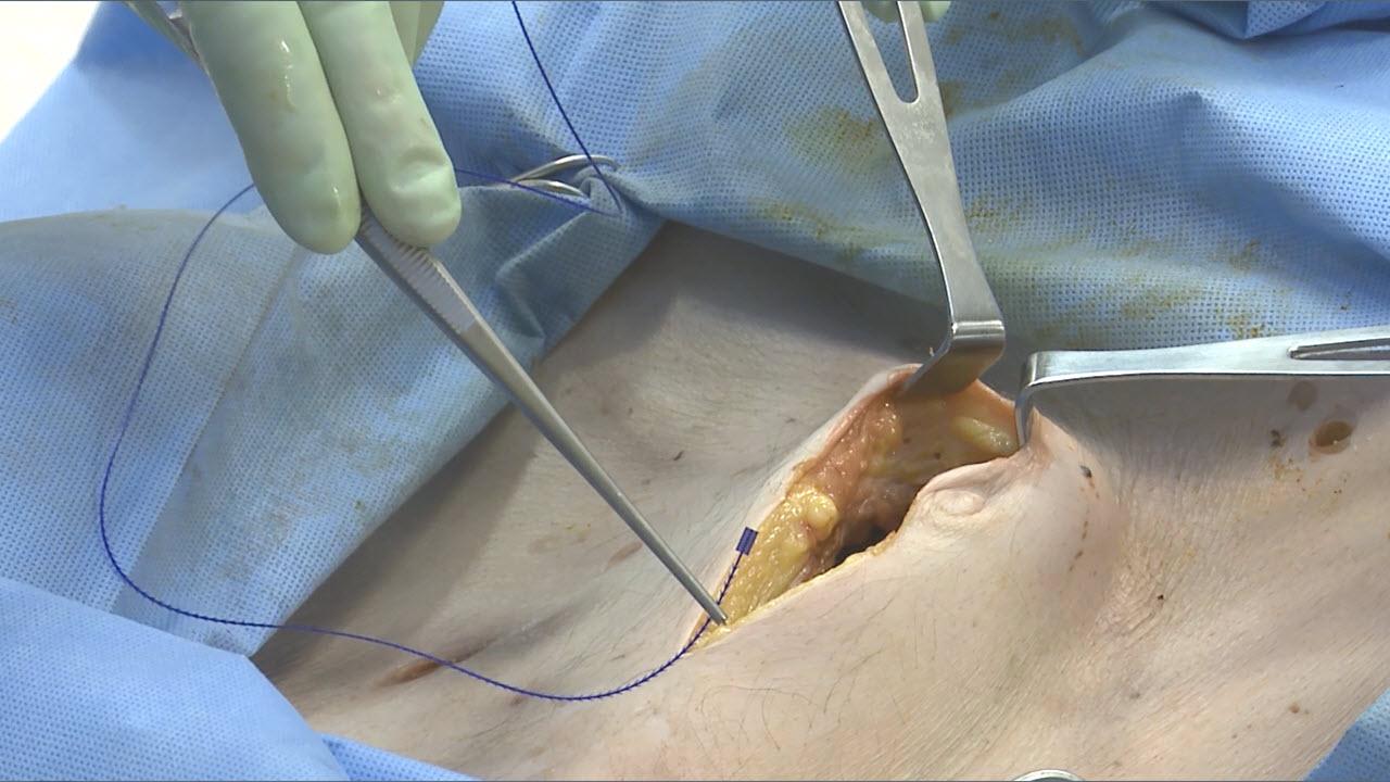 An image of the "Laparoscopic Left Colectomy & LAR - Step 8: Close with David Longcope, MD" video.
