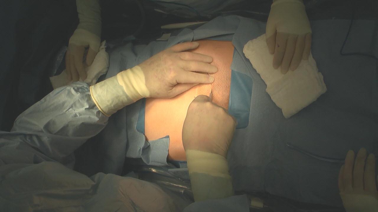Total Abdominal Hysterectomy Procedure With Dermabond Prineo 42cm Gynecology Johnson Johnson Institute