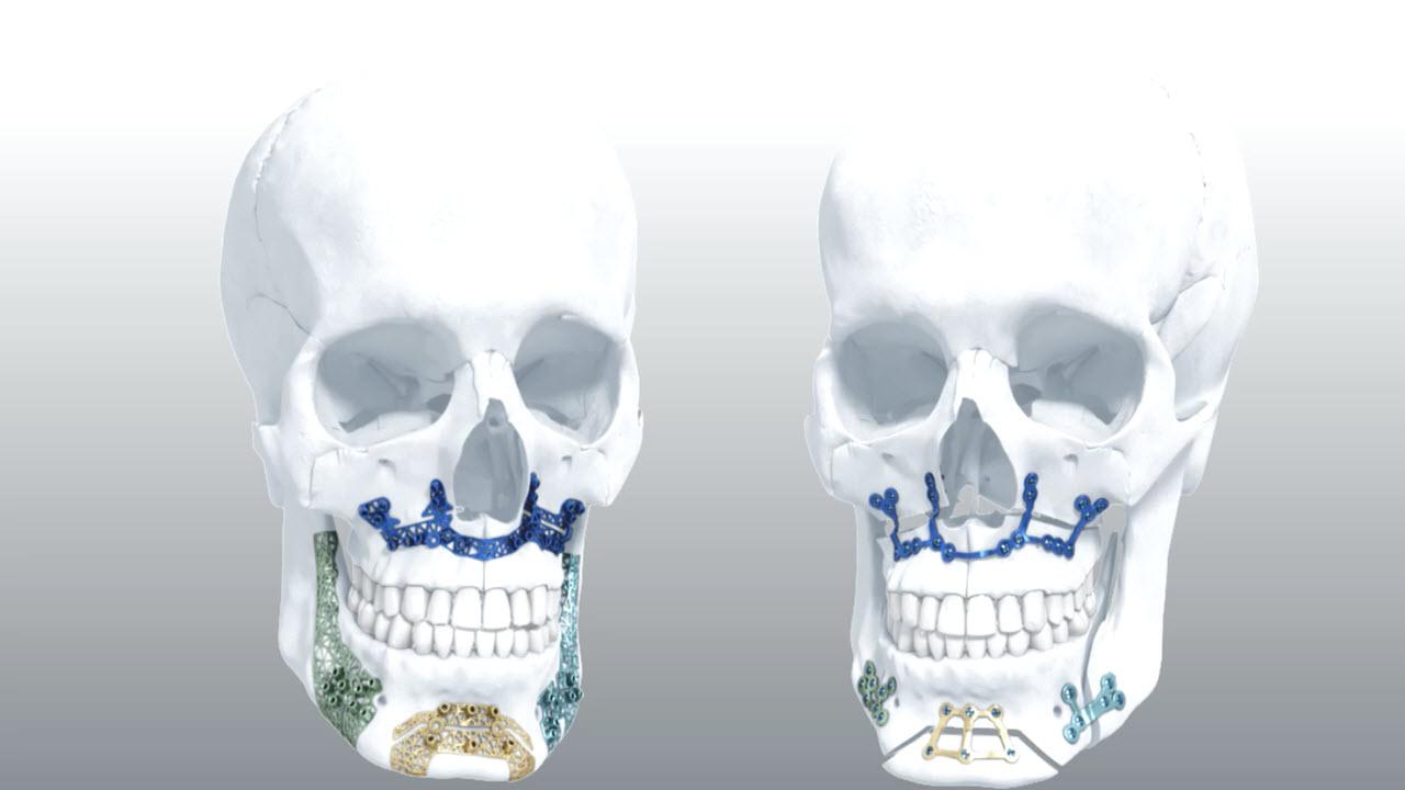An image of the "TRUMATCH® Orthognathics Technique Animation" video from the JnJInstitute.com website.