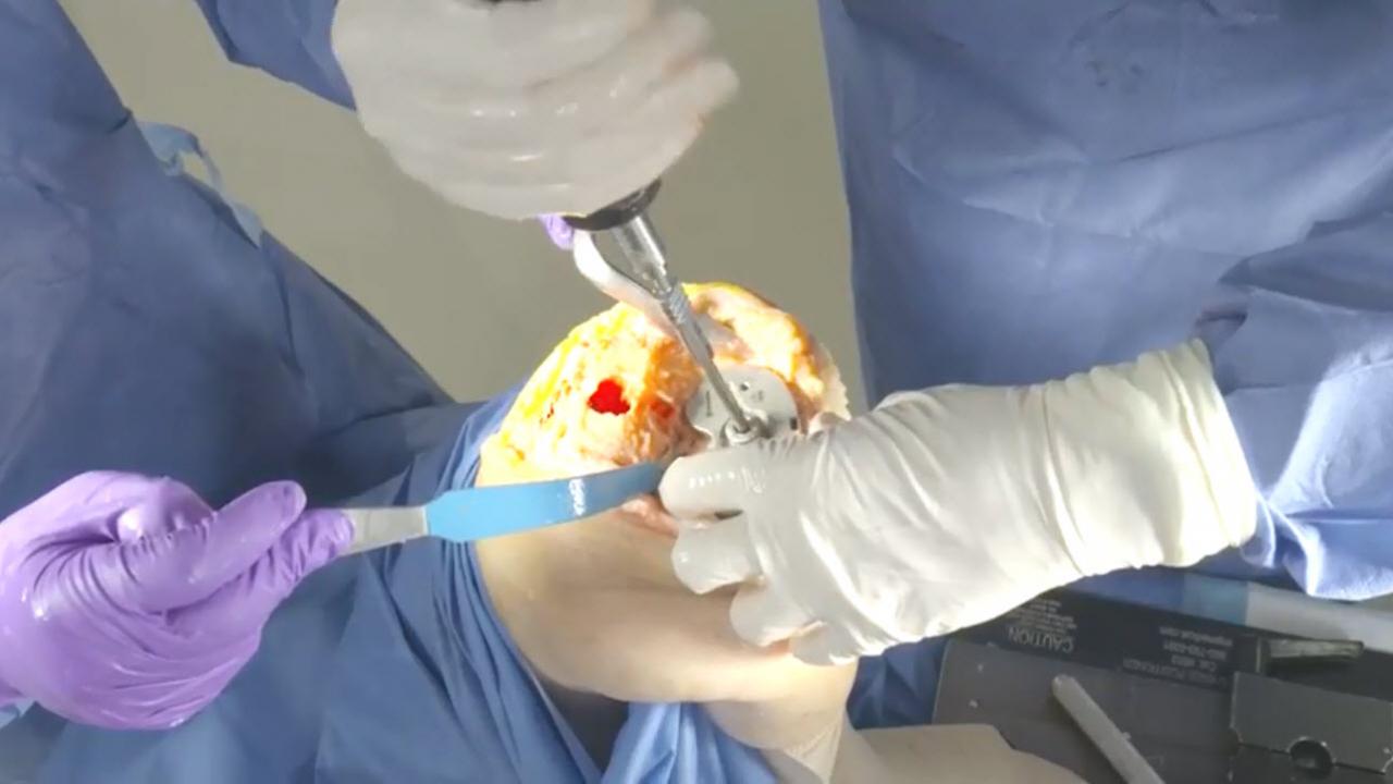 ATTUNE® Revision Rotating Platform Knee System with Tibial