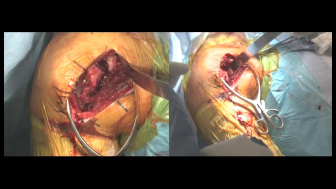 Image of the GLOBAL® STEPTECH® Anchor Peg Glenoid Surgery featuring Joseph Iannotti, MD video.