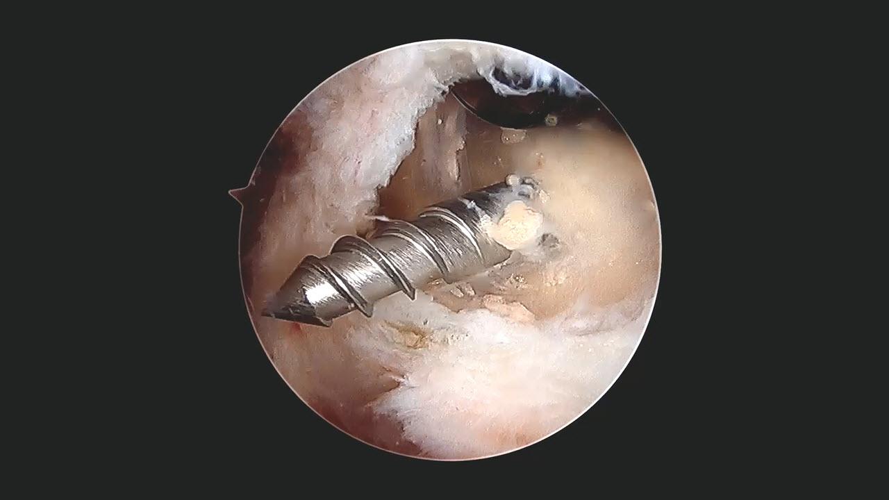 An image of the "Subscapularis Repair Featuring the EXPRESSEW® III Autocapture+ Flexible Suture Passer (Shoulder Arthroscopy)" video.