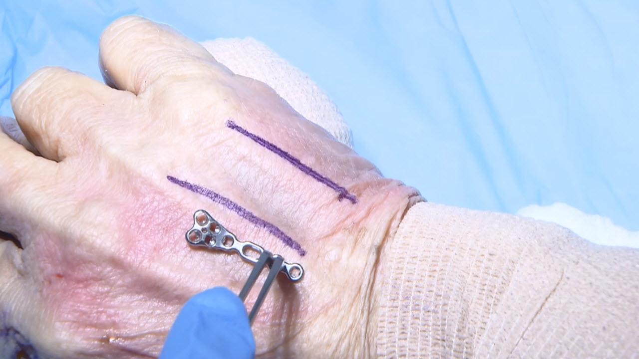 An image of the "VA Locking Hand System - Metacarpal Neck Plate with Marc Richard, MD" video.